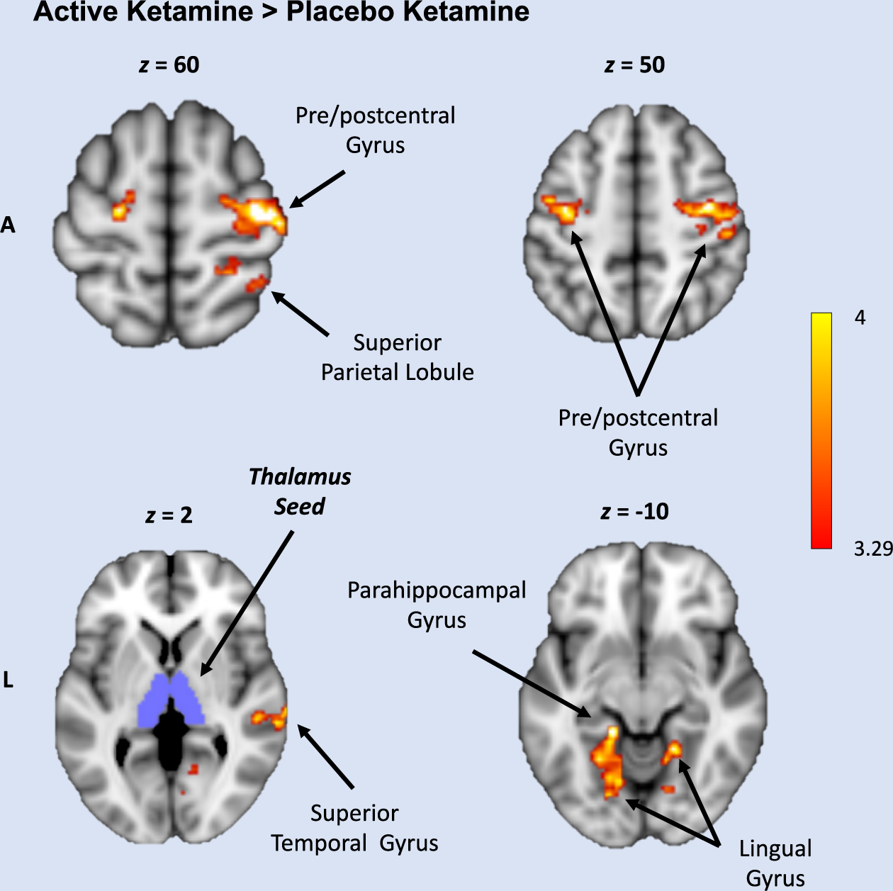 Validation of ketamine as a pharmacological model of thalamic  dysconnectivity across the illness course of schizophrenia | Molecular  Psychiatry