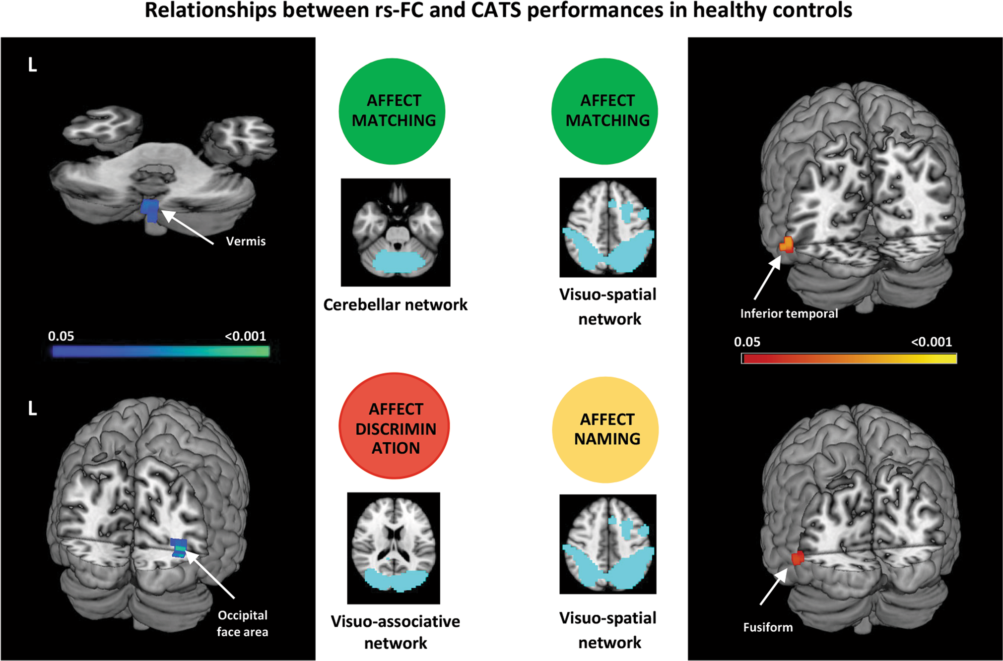 Resting state functional brain networks associated with emotion processing  in frontotemporal lobar degeneration | Molecular Psychiatry
