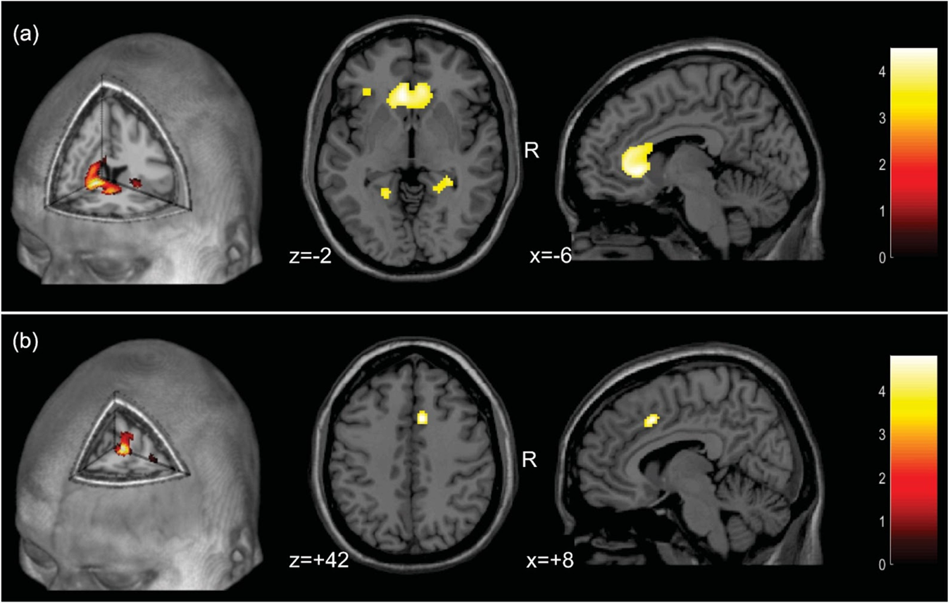 Fig. 3: Brain correlates of visuoconstructional performance in mild COVID-19 patients.