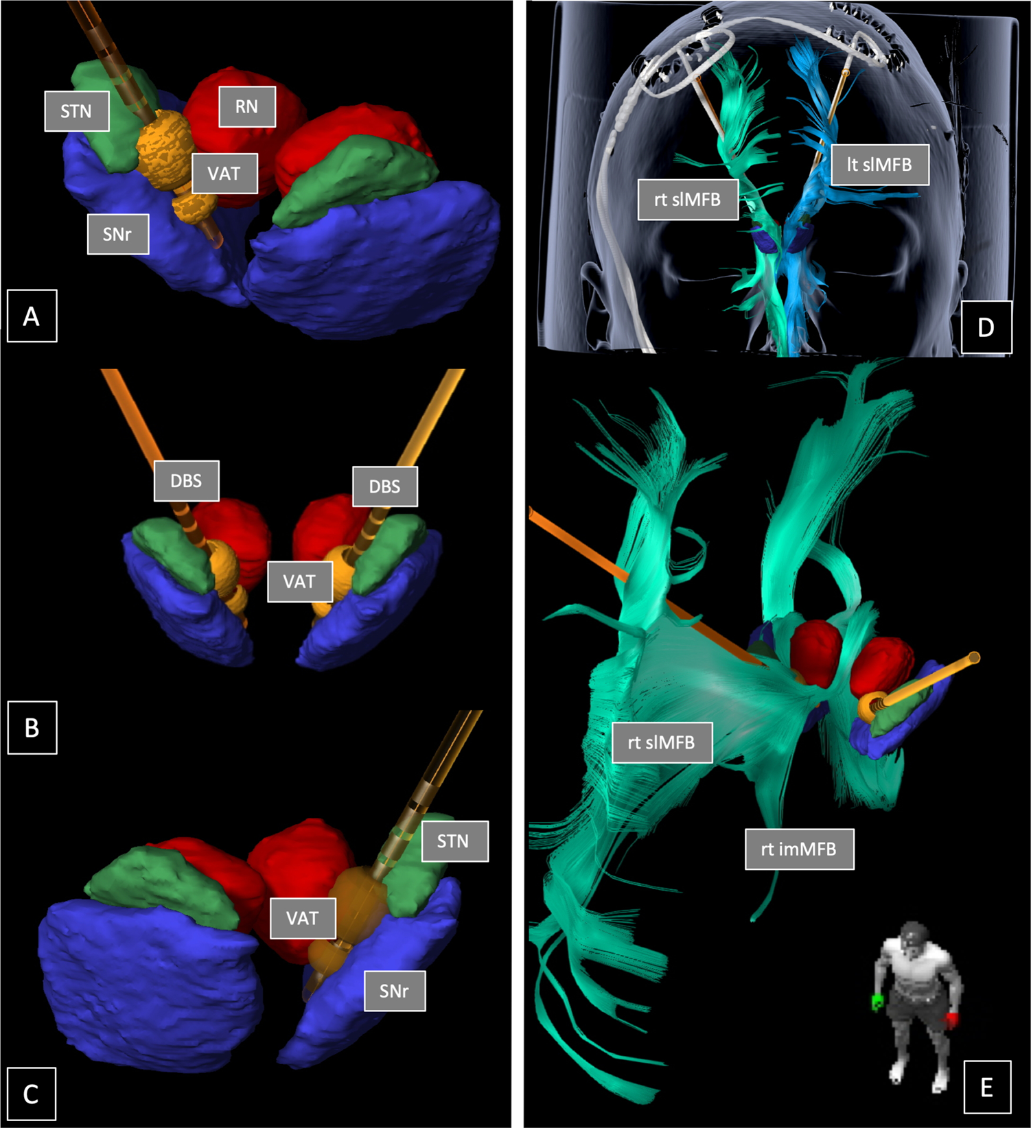 Superolateral medial forebrain bundle deep brain stimulation in major  depression: a gateway trial | Neuropsychopharmacology