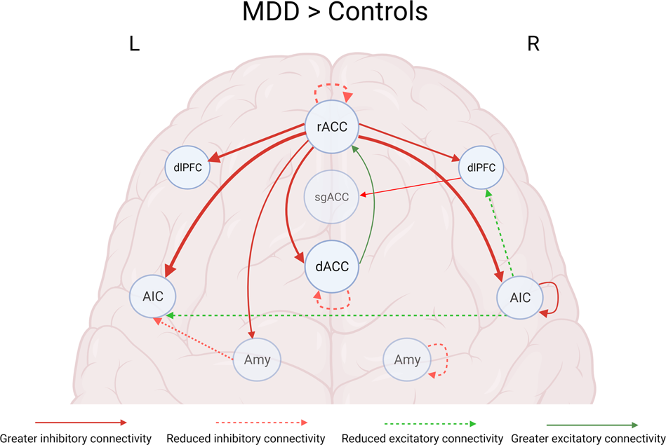 Prevalence of medial depression of the mandibu- lar ramus (MDMR) in the