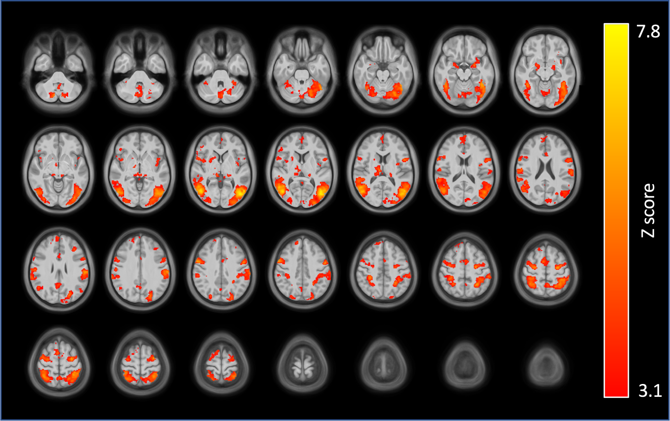 Region-Specific Effects of Nicotine on Brain Activity: A Pharmacological  MRI Study in the Drug-Naïve Rat