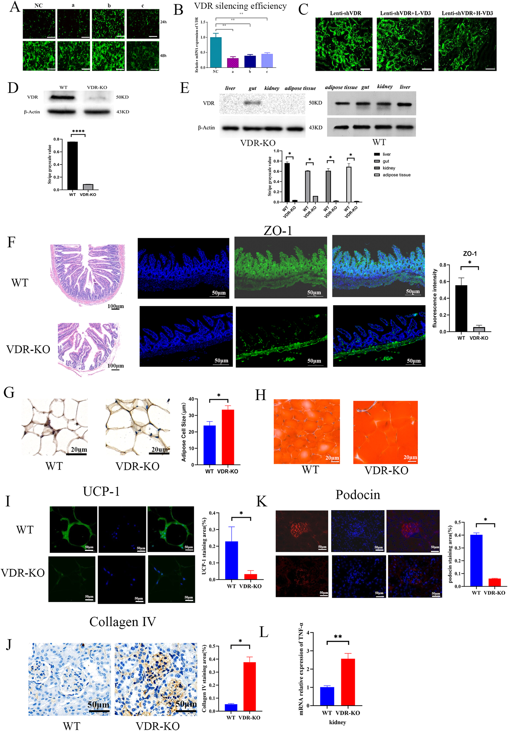 Fig. 4: Inhibition of VDR expression affects the function of glomerular podocytes in DKD patients.