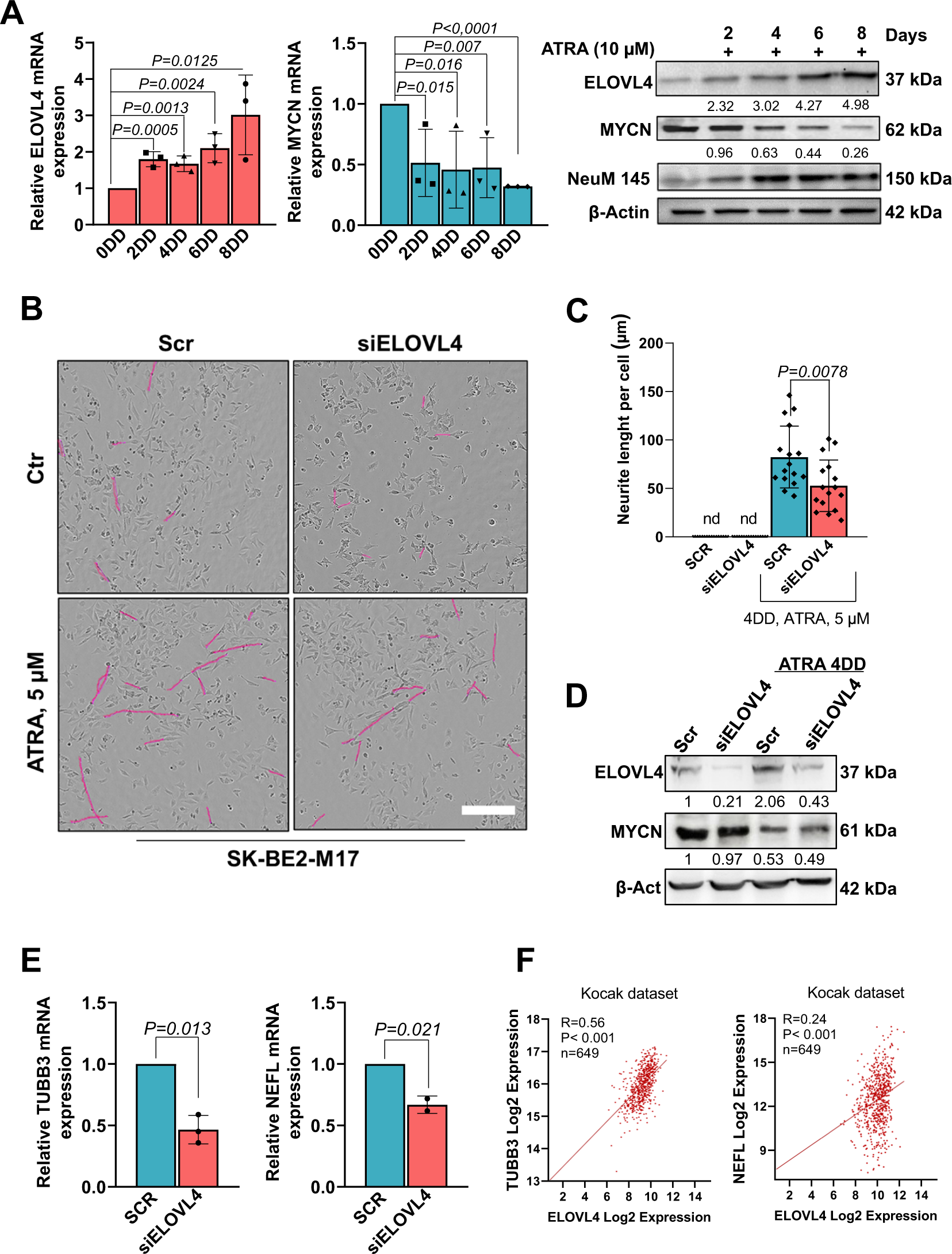 The Expression Of Elovl4 Repressed By Mycn Defines Neuroblastoma Patients With Good Outcome Oncogene