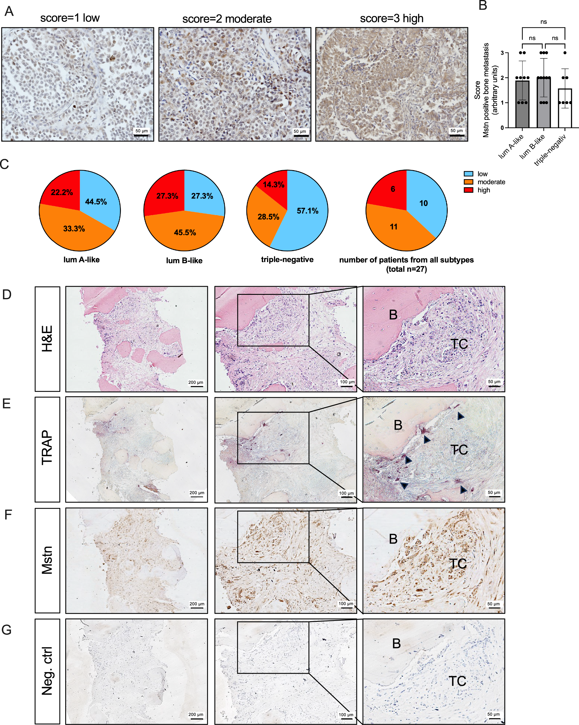 Fig. 1: Breast cancer bone metastases is Mstn-positive and located in the osteoclast-bone-tumor interface.