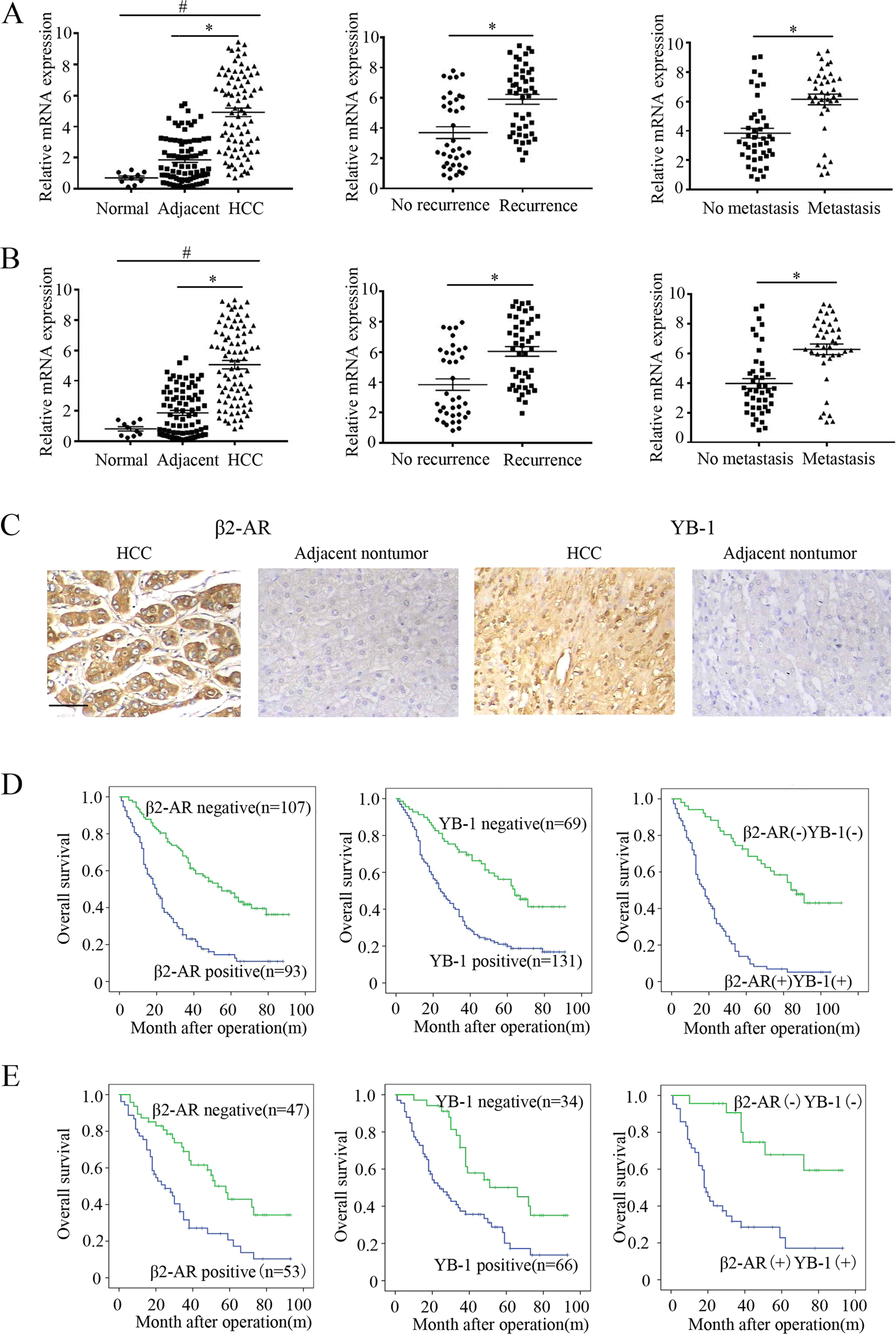 A novel β2-AR/YB-1/β-catenin axis mediates chronic stress-associated  metastasis in hepatocellular carcinoma | Oncogenesis