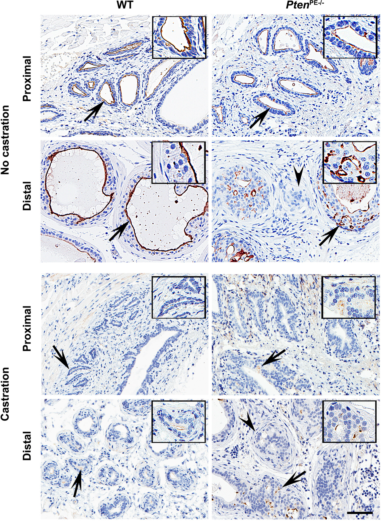 Membrane metalloendopeptidase suppresses prostate carcinogenesis