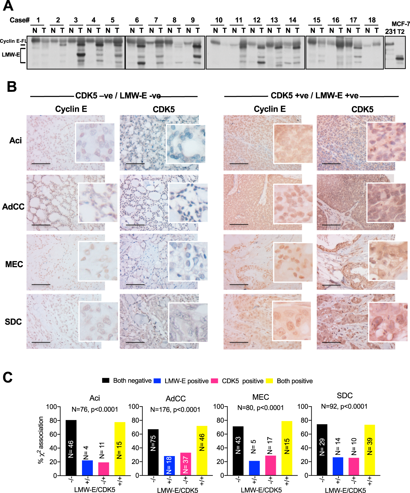 Fig. 4: LMW-E and CDK5 are co-expressed in human salivary gland tumors.