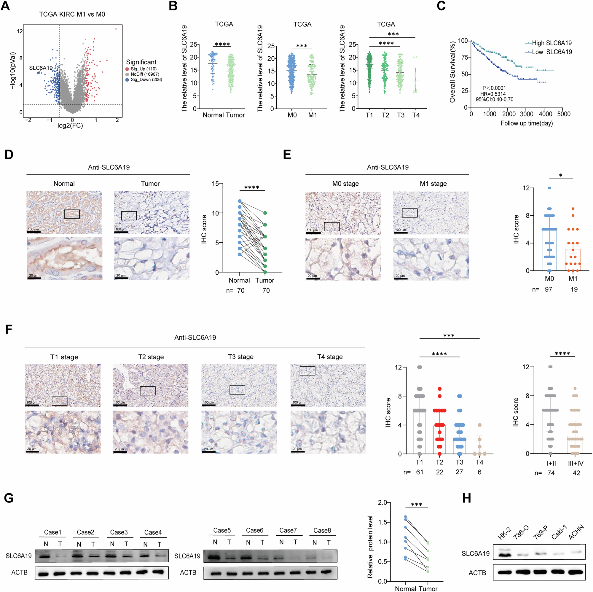 Fig. 1: Identify SLC6A19 as a candidate tumor suppressor gene in RCC.