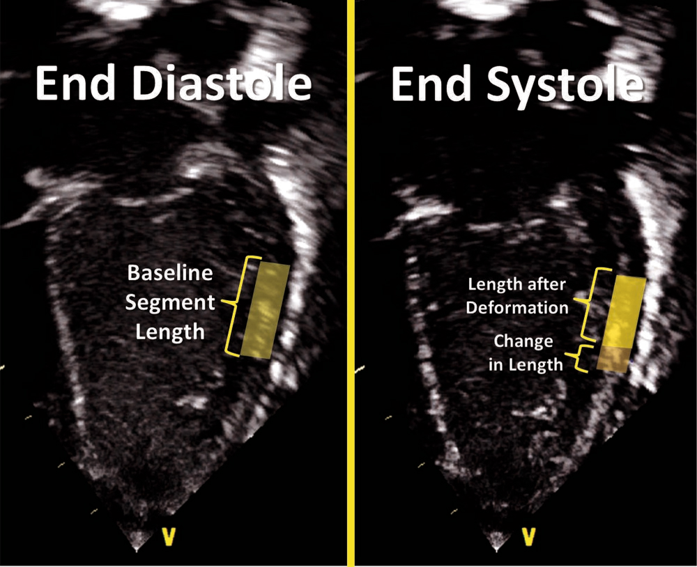 Myocardial Deformation Imaging