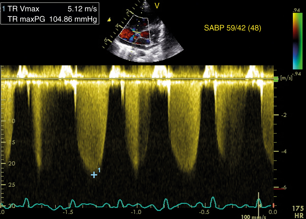 PROGNOSTIC VALUE OF PERSISTENTLY ABNORMAL LEFT VENTRICULAR GLOBAL  LONGITUDINAL STRAIN IN PATIENTS WITH SUBARACHNOID HEMORRHAGE