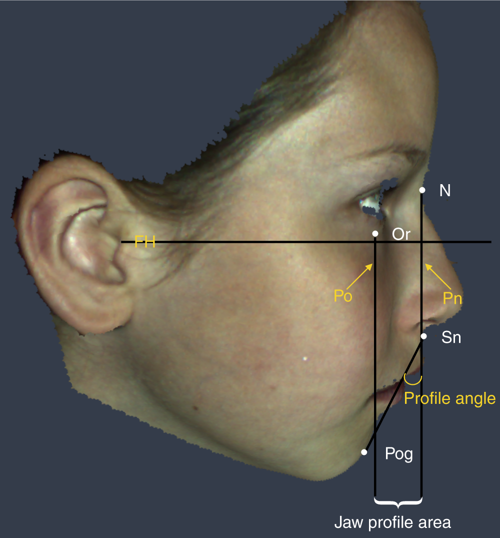 Fetal alcohol syndrome images adults