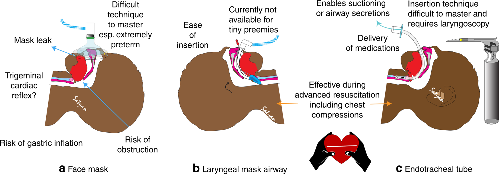 Laryngeal mask airway: an alternate option for all phases of neonatal  resuscitation | Pediatric Research