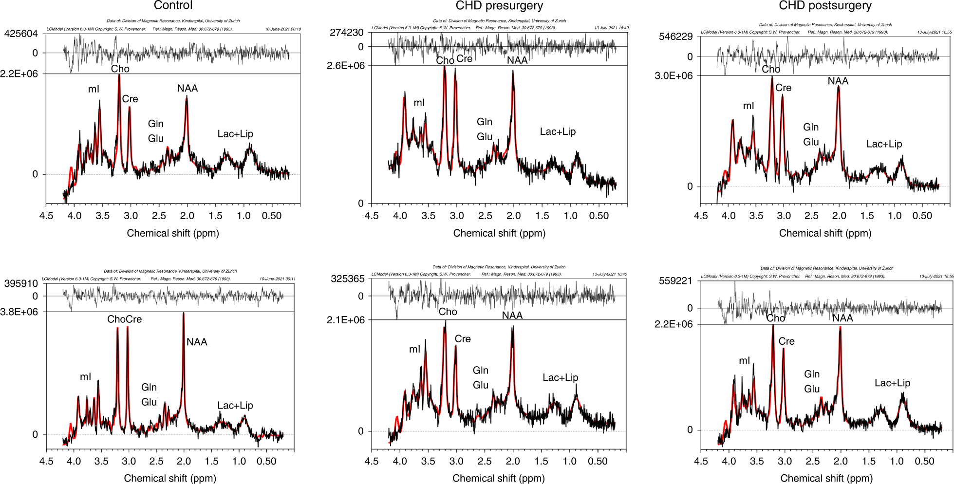 Fig. 2: Representative spectra of control and patient pre- and postoperatively.