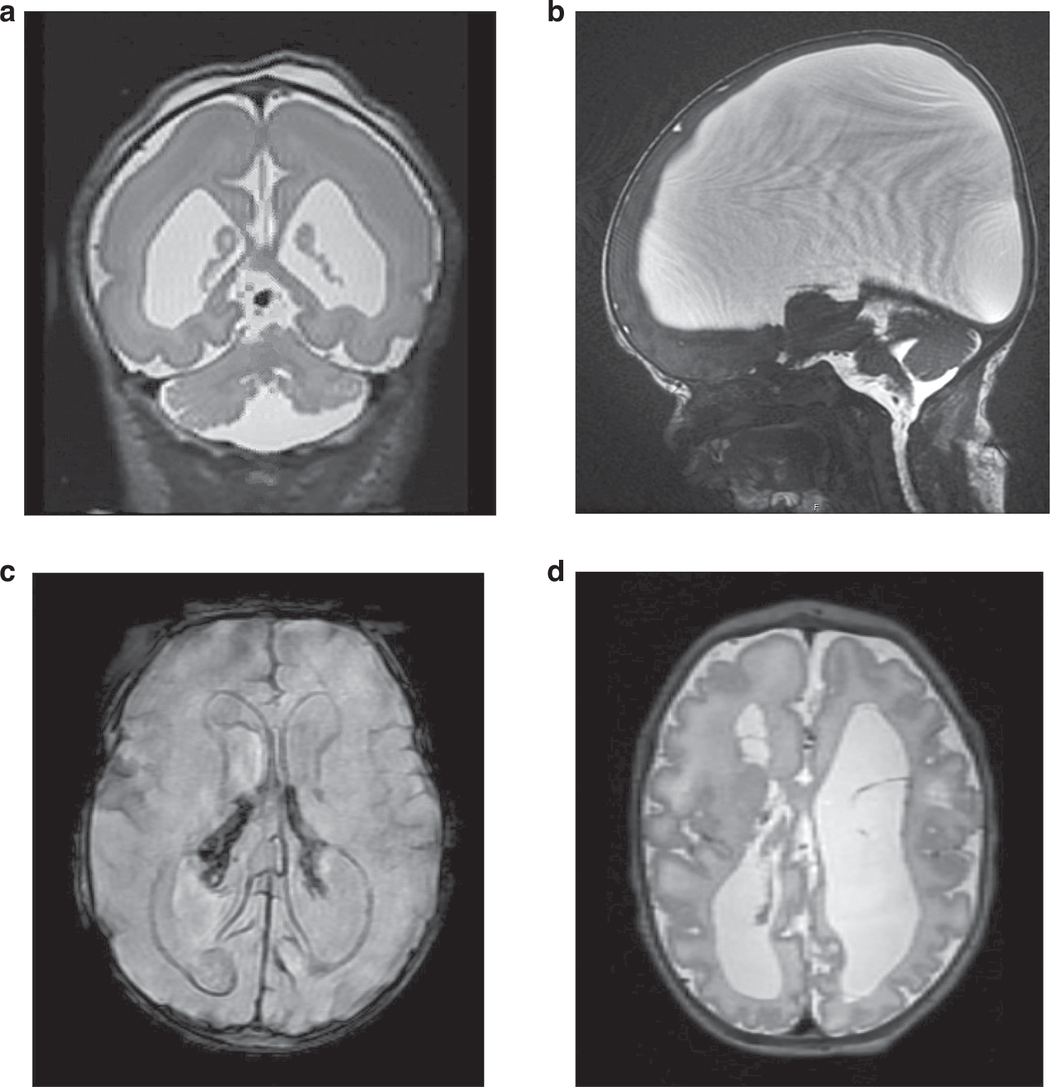 Fig. 2: Examples of neonatal MRI findings in selected genetic disorders with initial prenatal presentation.