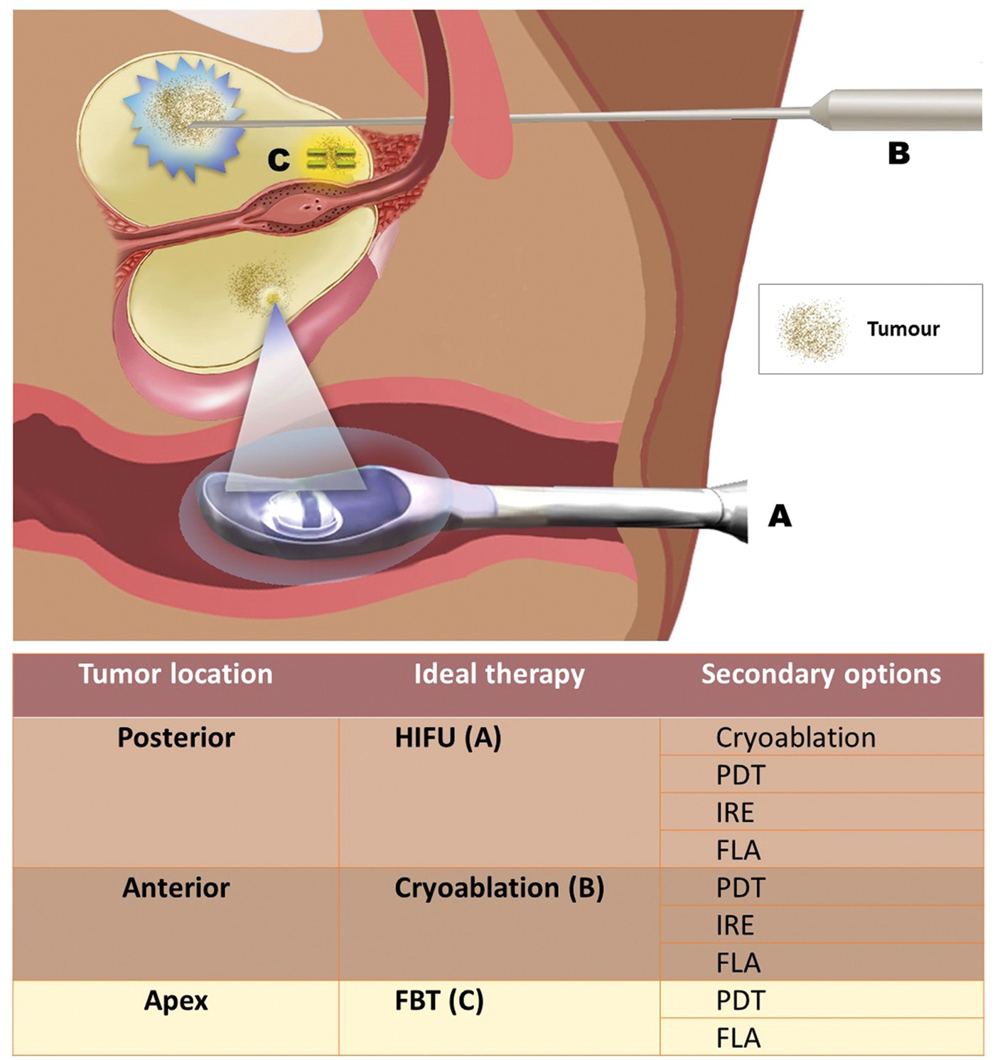 Which technology to select for primary focal treatment of prostate  cancer?—European Section of Urotechnology (ESUT) position statement |  Prostate Cancer and Prostatic Diseases