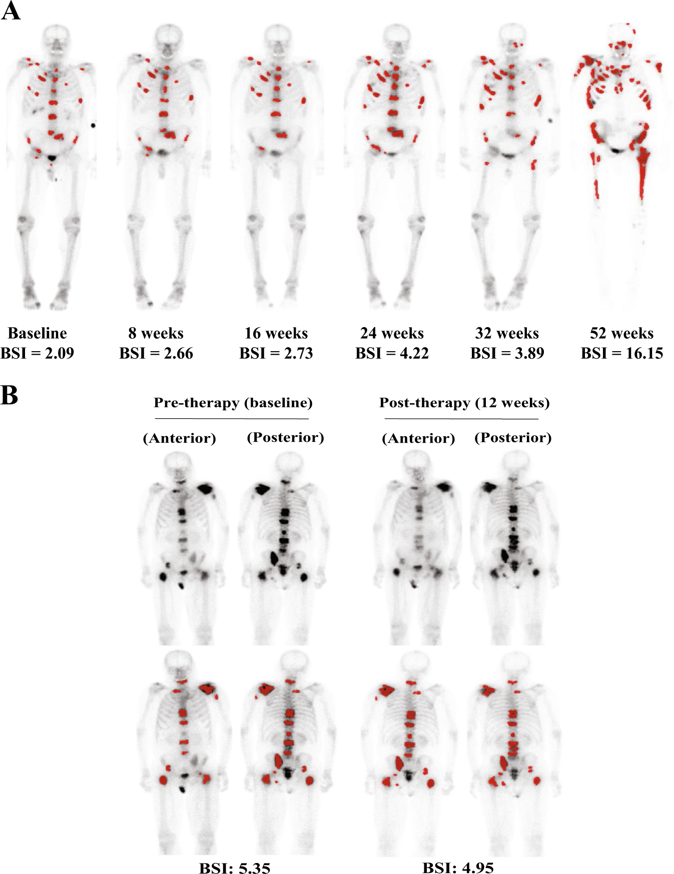 Measuring the unmeasurable: automated bone scan index as a quantitative  endpoint in prostate cancer clinical trials | Prostate Cancer and Prostatic  Diseases, image size:1347x1747