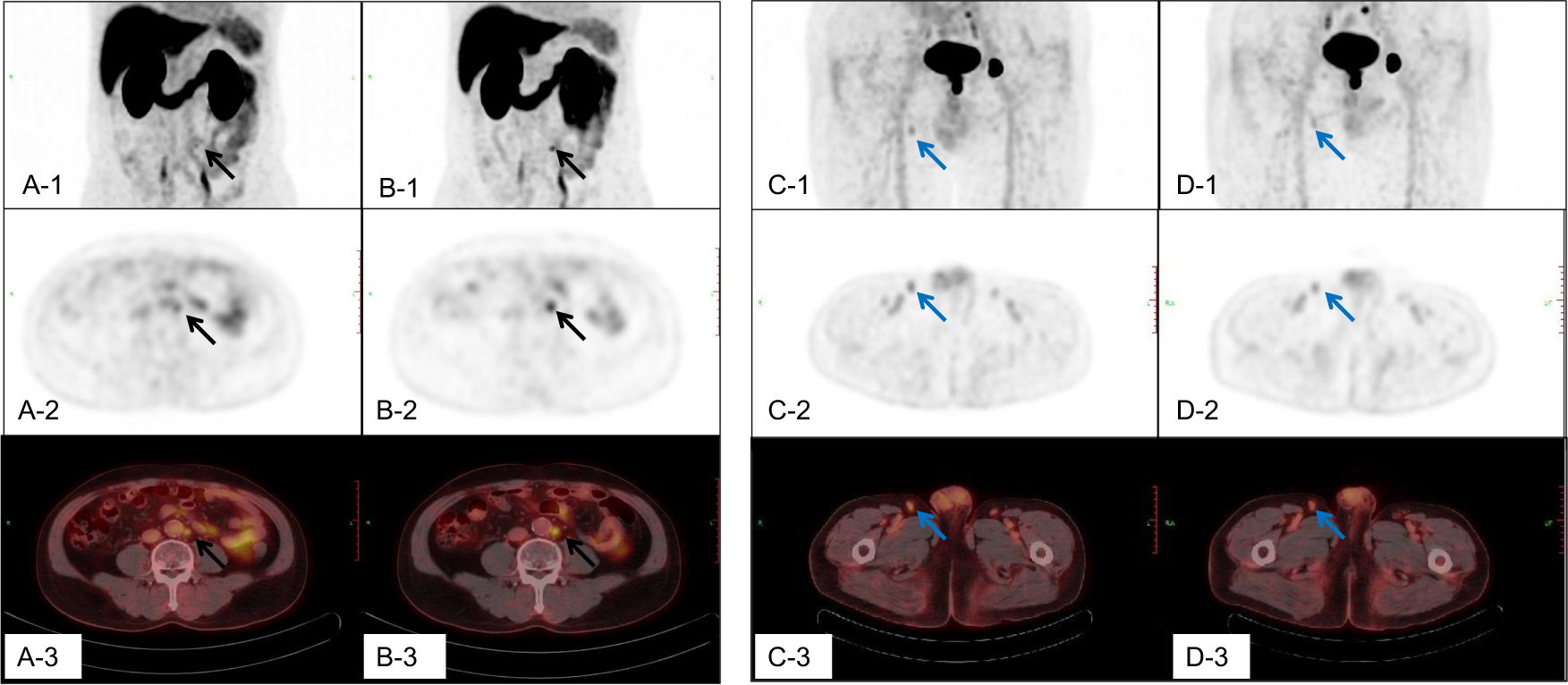 Changes in Management After 18F-DCFPyL PSMA PET in Patients