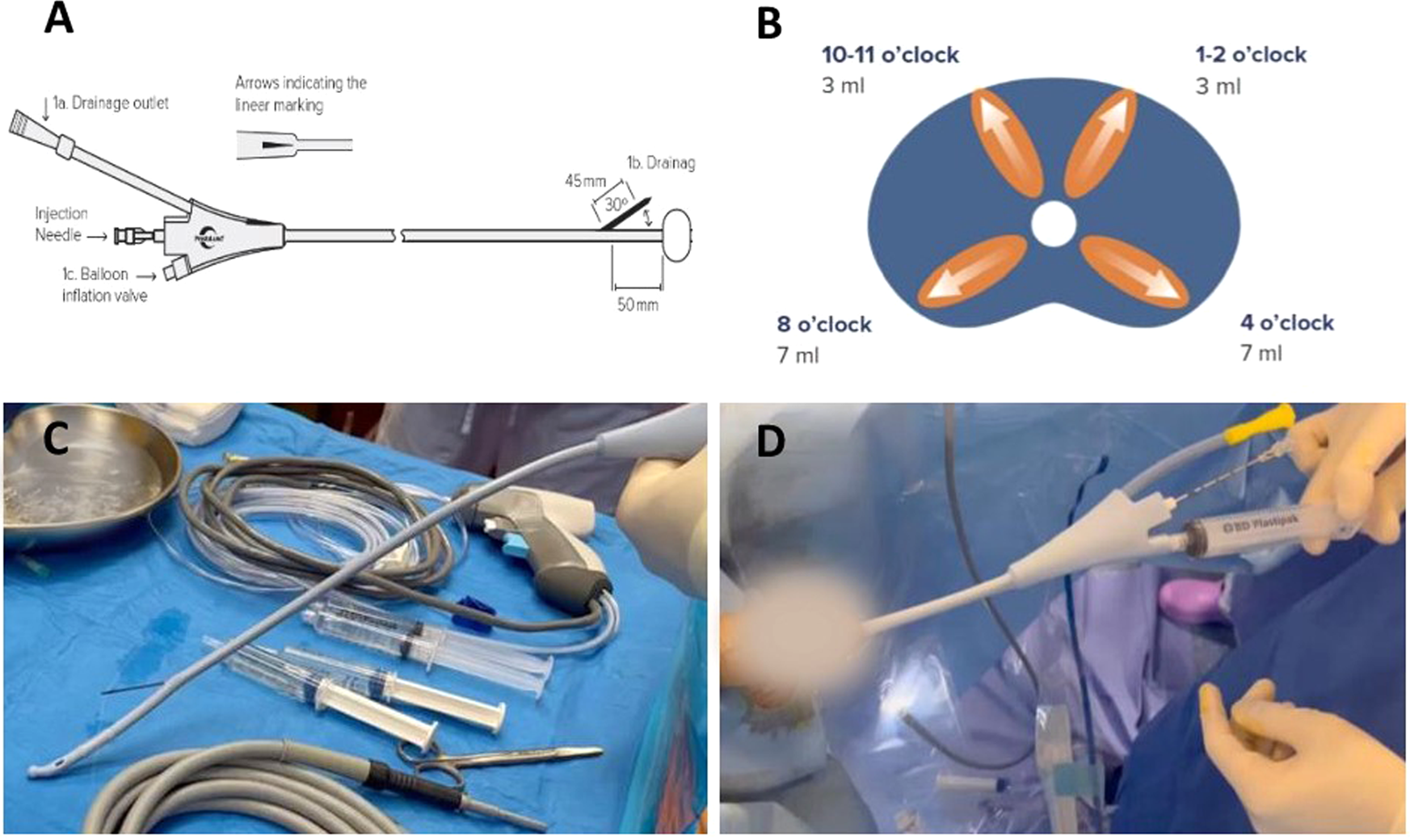 Use of a Schelin Catheter for analgesia during Rezum treatment of 