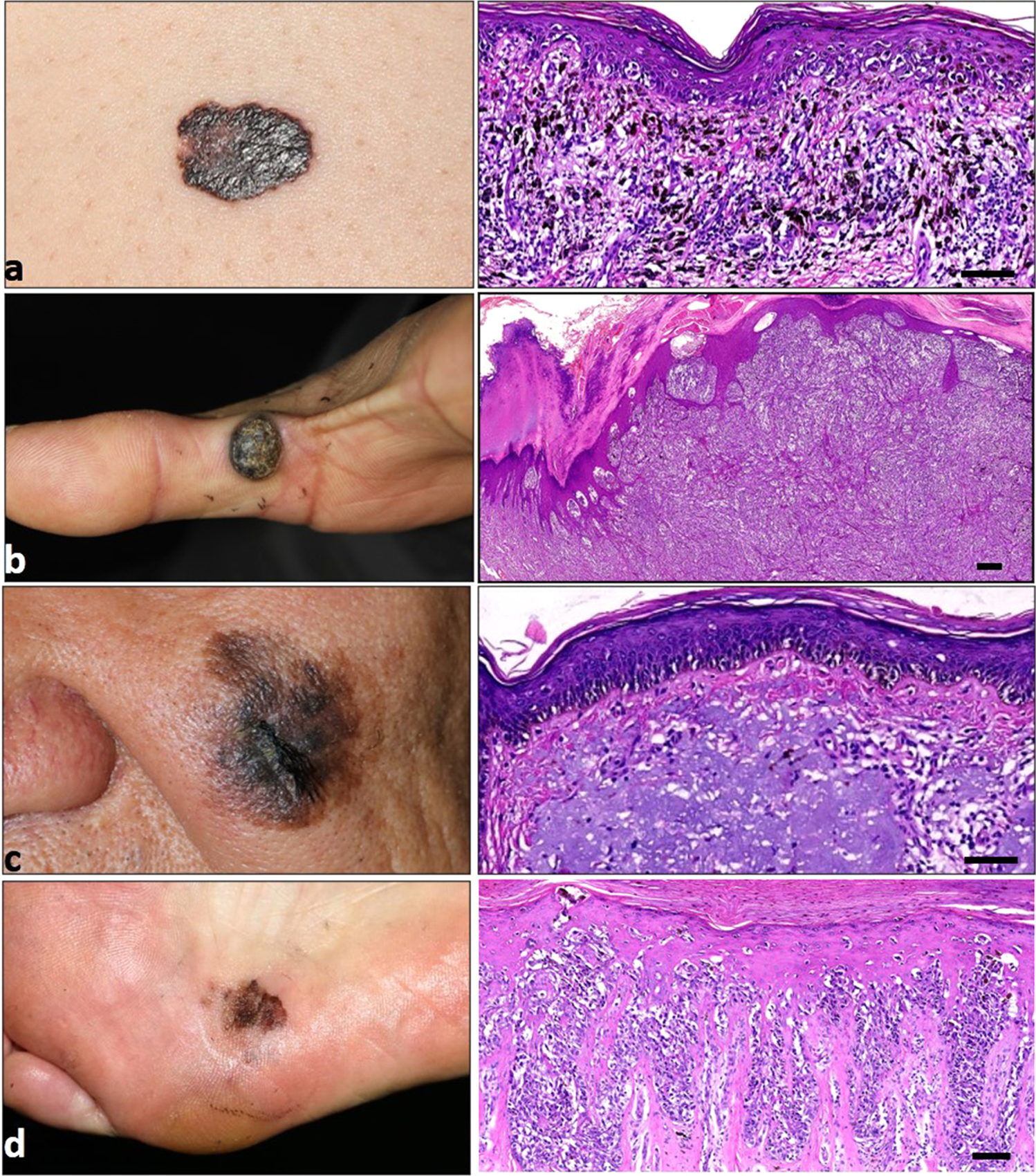 Noninvasive identification of Benign and malignant eyelid tumors using  clinical images via deep learning system | Journal of Big Data | Full Text