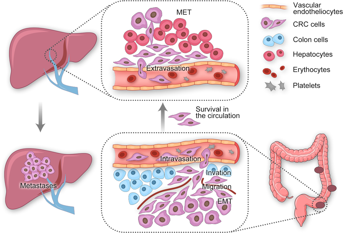 Colorectal liver metastasis: molecular mechanism and interventional therapy  | Signal Transduction and Targeted Therapy