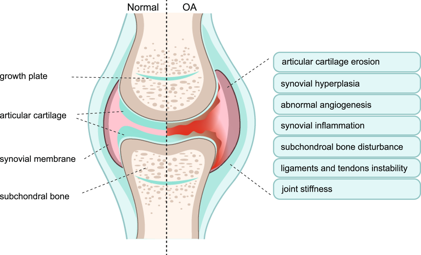 Osteoarthritis: pathogenic signaling pathways and therapeutic targets