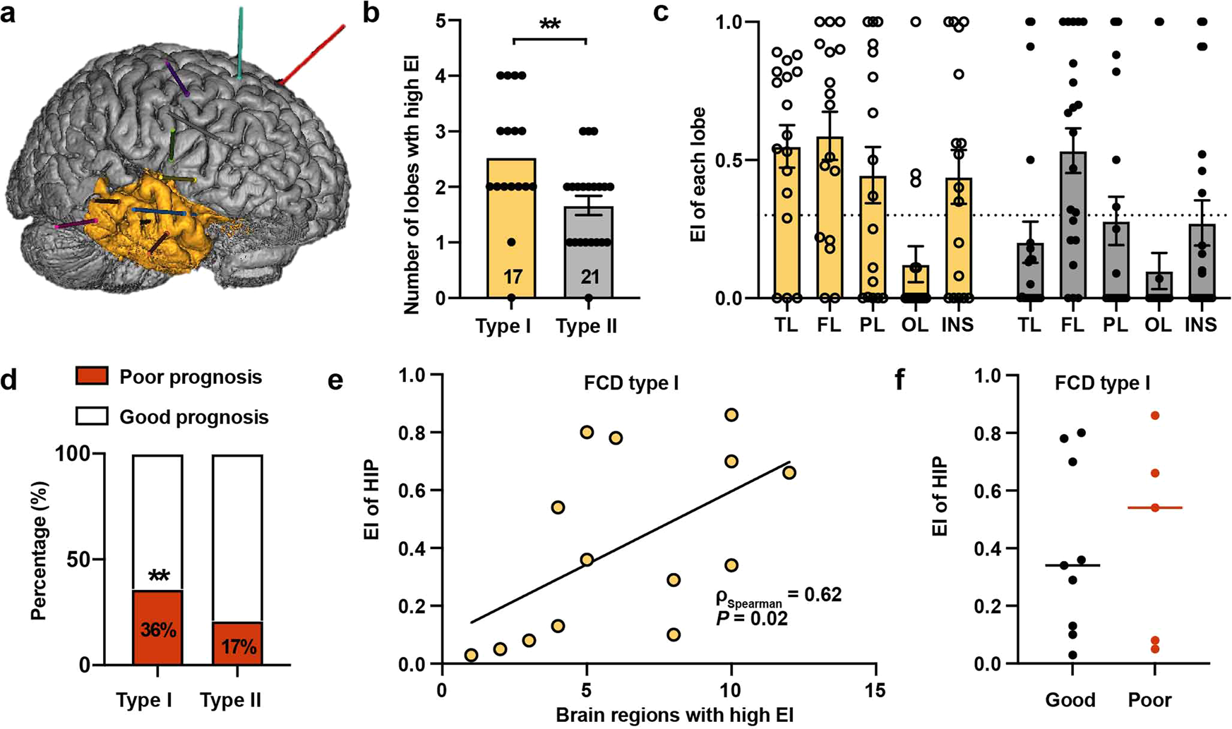Excitatory somatostatin interneurons in the dentate gyrus drive a  widespread seizure network in cortical dysplasia | Signal Transduction and  Targeted Therapy