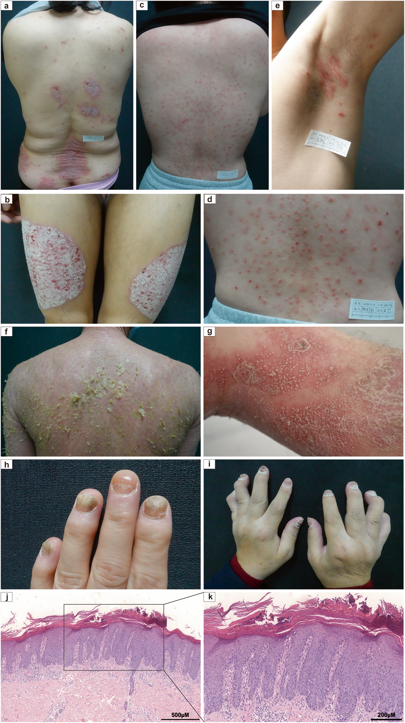 Holistic Approach for Psoriasis Treatment - Functional Medicine