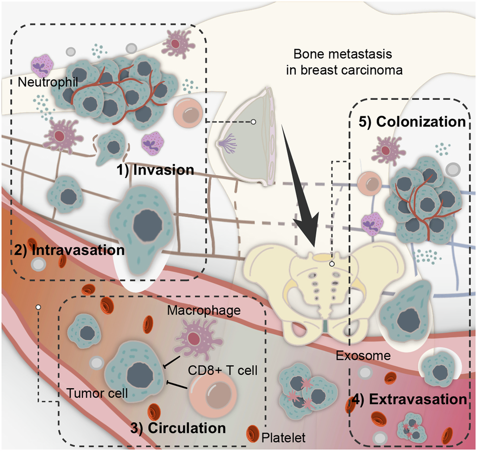 Multi-stage mechanisms of tumor metastasis and therapeutic strategies |  Signal Transduction and Targeted Therapy