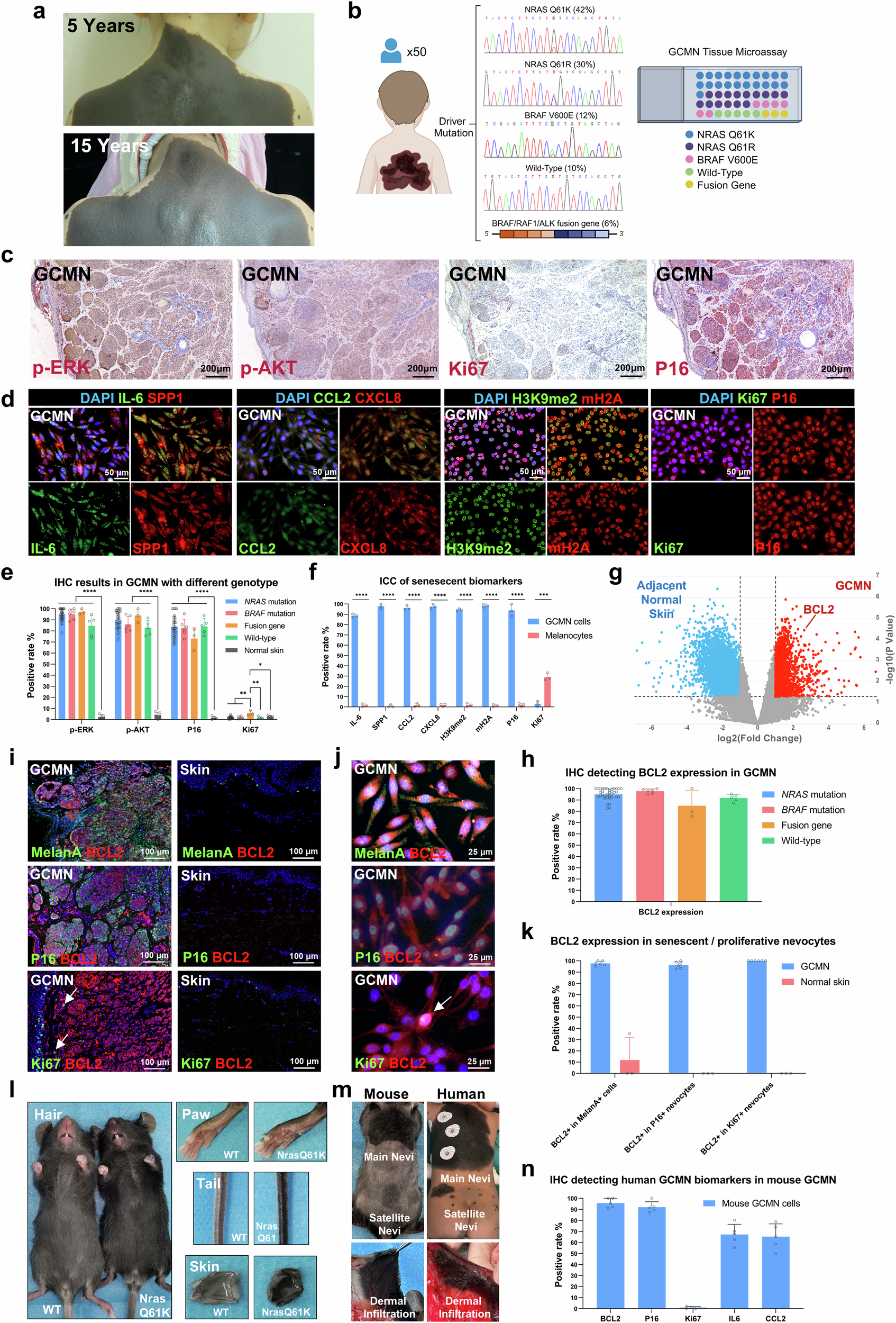 clav melanotan Anti-BCL2 therapy eliminates giant congenital melanocytic nevus by senolytic and immune induction Cellular health