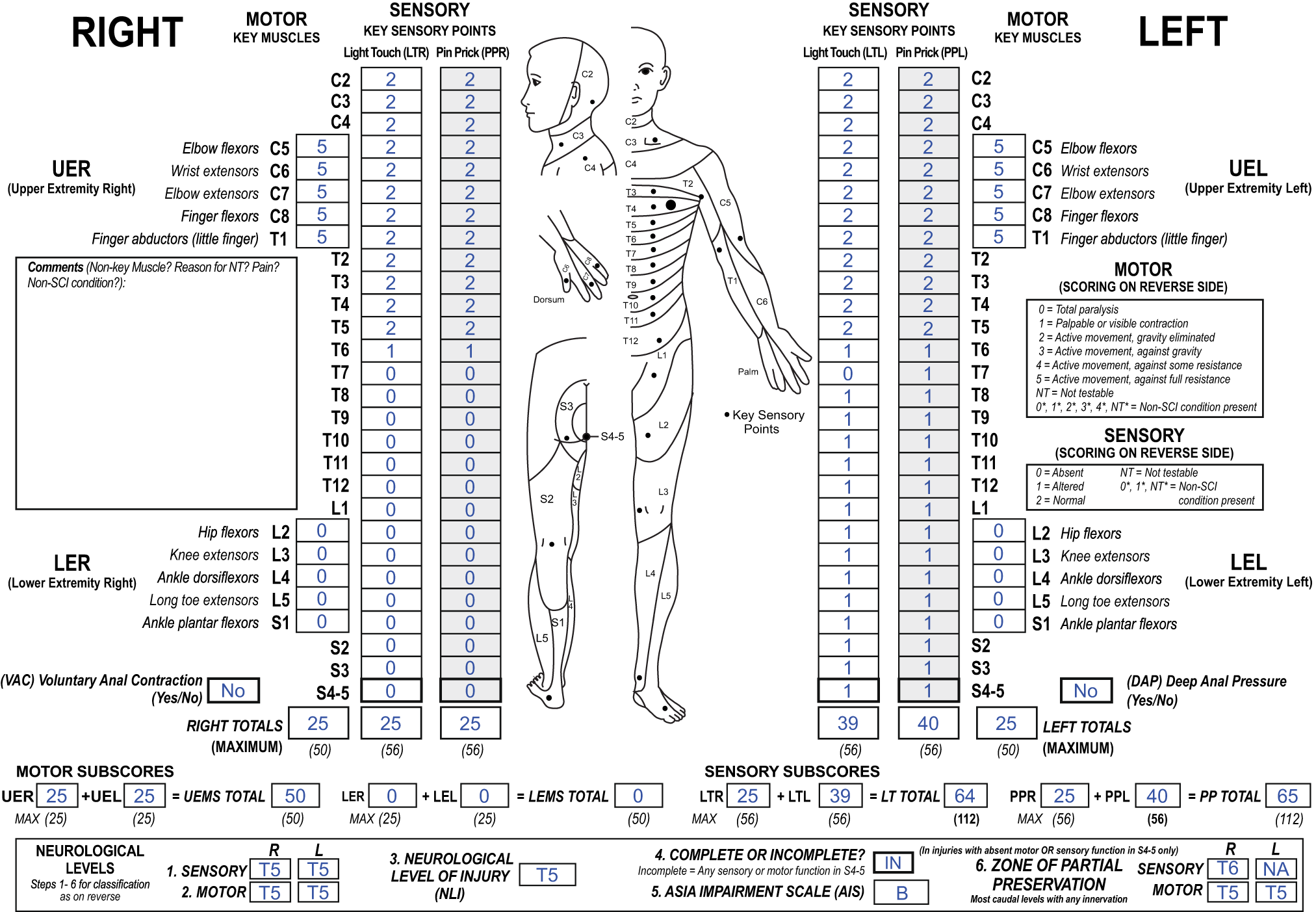 Fig. 3: International Standards for Neurological Classification of Spinal Cord Injury (ISNCSCI) example of a rare case with a unilateral sensory zone of partial preservation (ZPP).