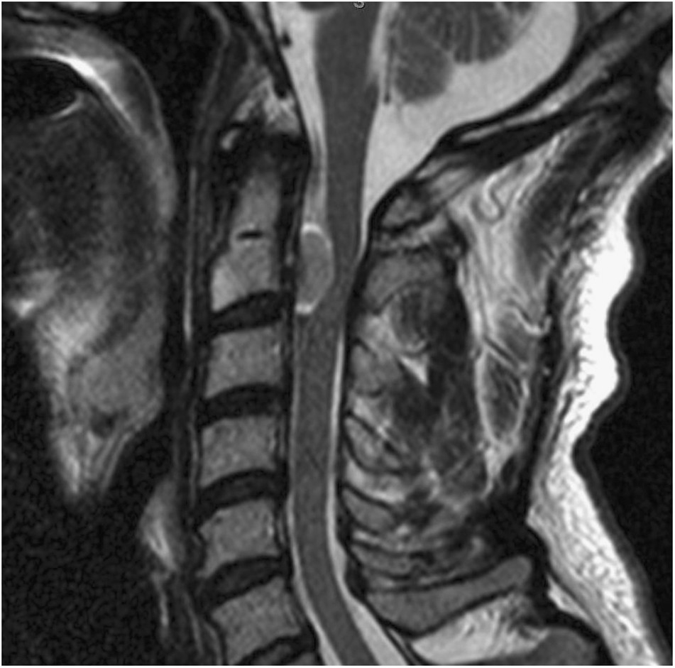 Excision of a centrally based ventral intradural extramedullary tumor of  the cervical spine through a direct posterior approach | Spinal Cord Series  and Cases