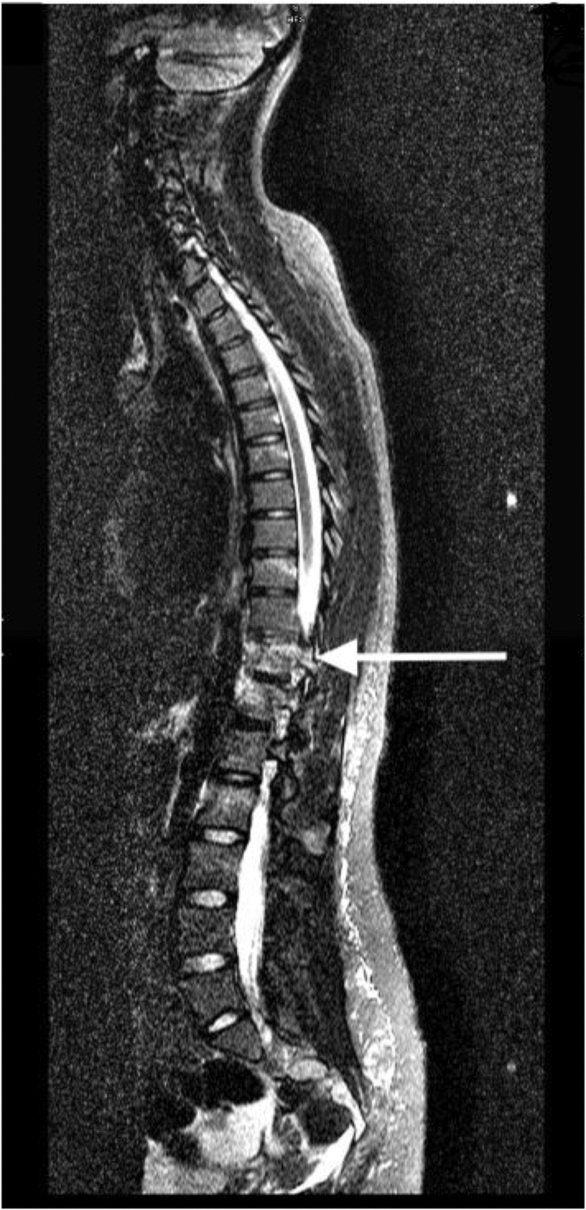 Dual spinal cord injury: a case of acute traumatic T9 AIS A spinal cord  injury complicated by transverse myelitis | Spinal Cord Series and Cases