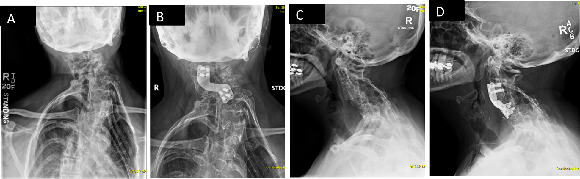 Klippel-Feil Syndrome | PPTX, image size:1950x602