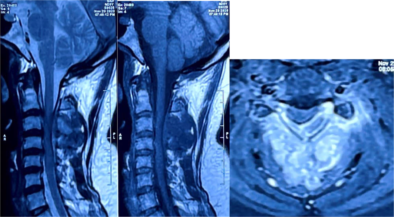 The Ewing's sarcoma of cervical spine—a rare occurrence