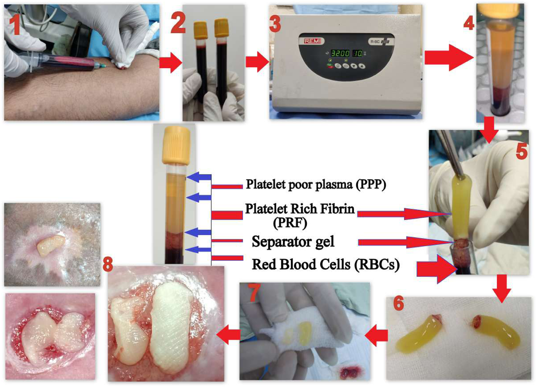 Picture of Platelet-rich fibrin