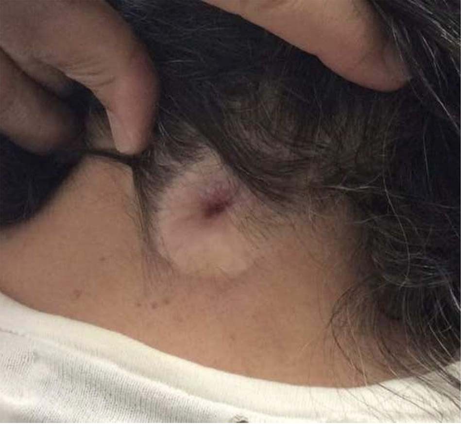 Posterior cervical congenital dermal sinus tract: case report and ...