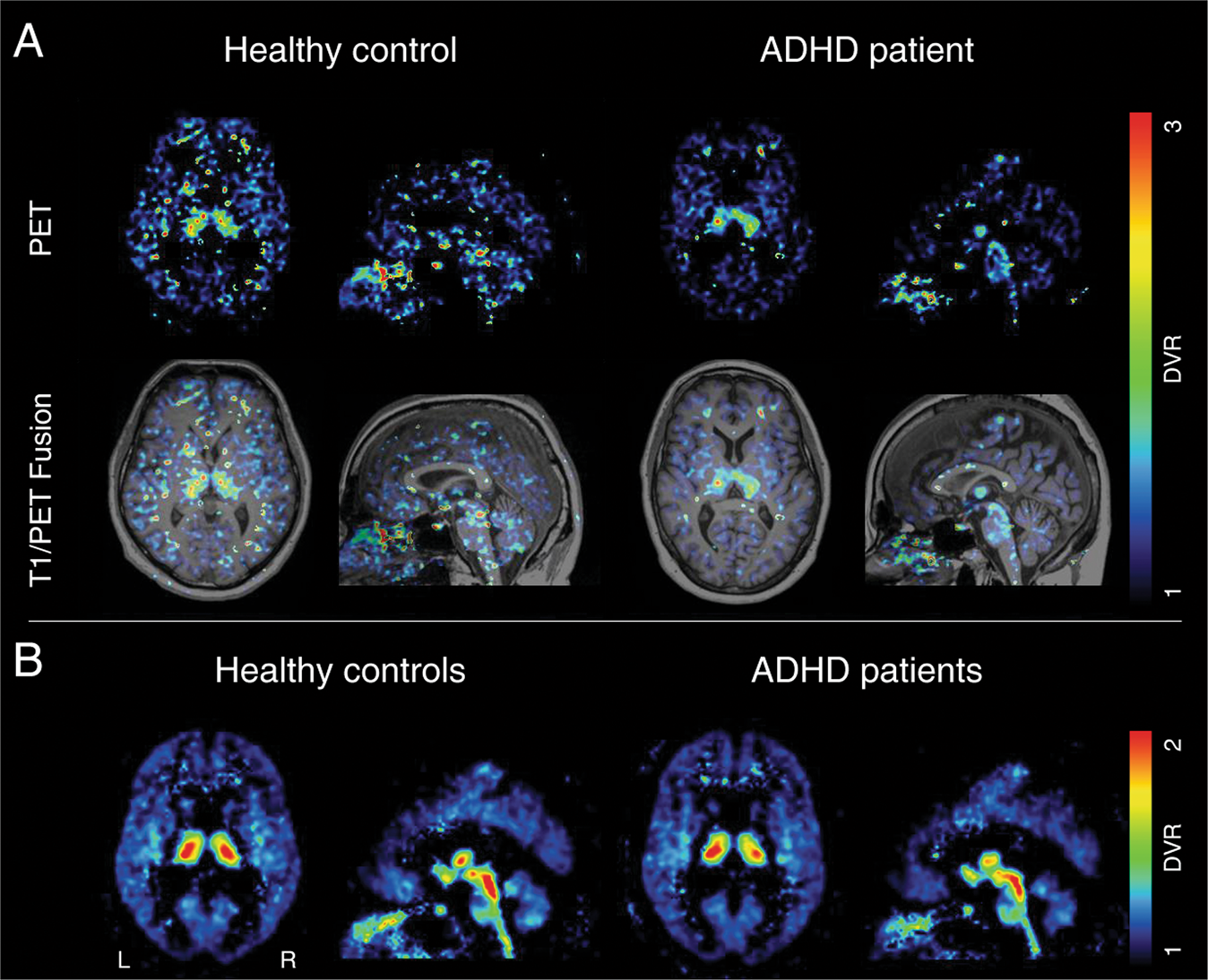 Adult disorder is associated with reduced norepinephrine transporter availability in right attention networks: a (S,S)-O-[11C]methylreboxetine positron emission tomography study | Translational Psychiatry