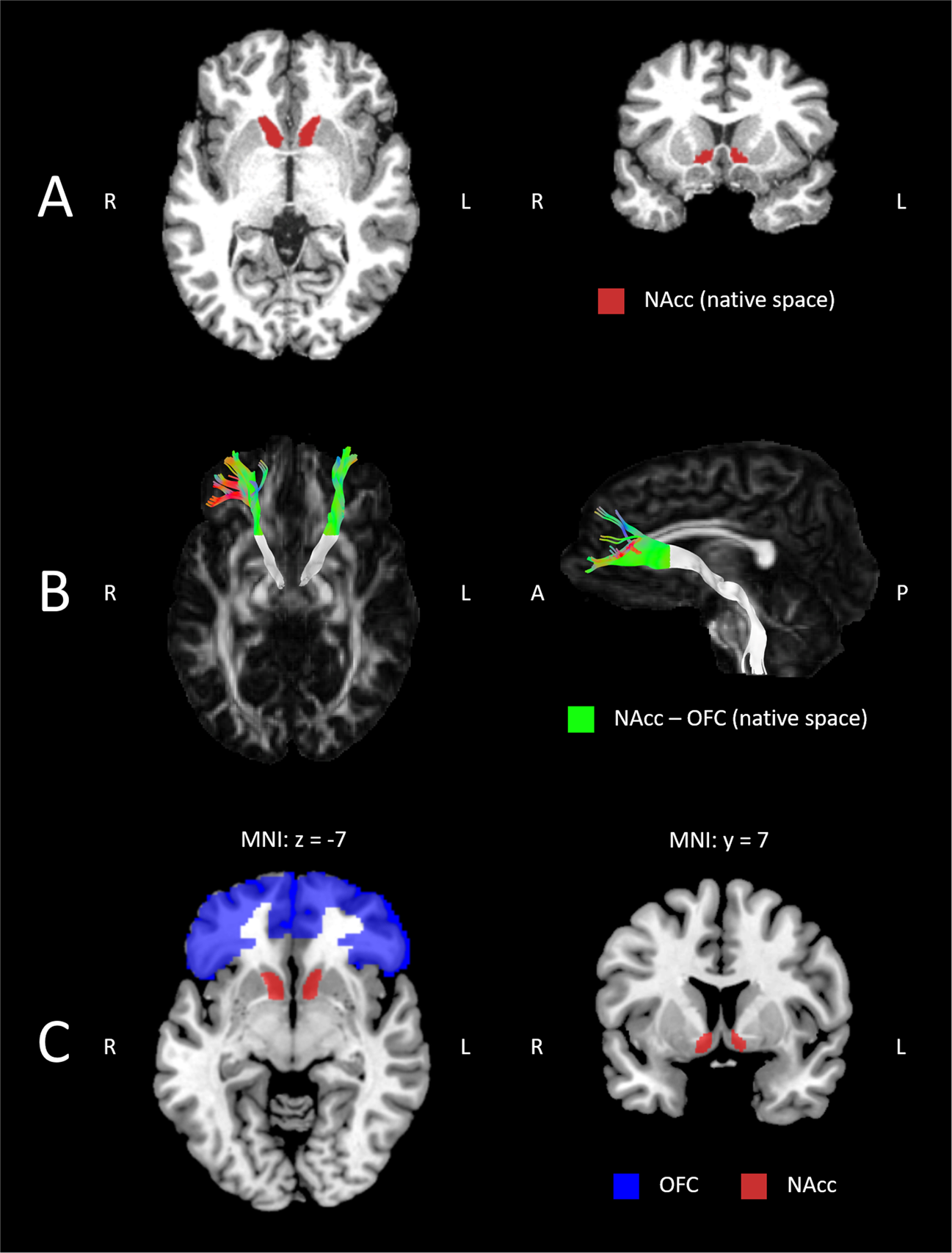 The role of the orbitofrontal cortex and the nucleus accumbens for craving  in alcohol use disorder | Translational Psychiatry