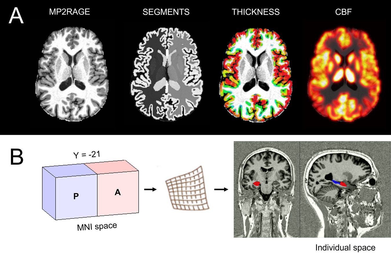 Distinct and shared patterns of brain plasticity during electroconvulsive  therapy and treatment as usual in depression: an observational multimodal  MRI-study | Translational Psychiatry