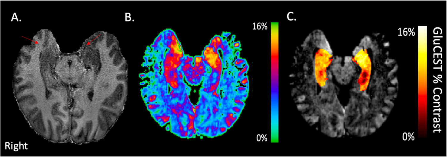 Elevating the field for applying neuroimaging to individual patients in  psychiatry