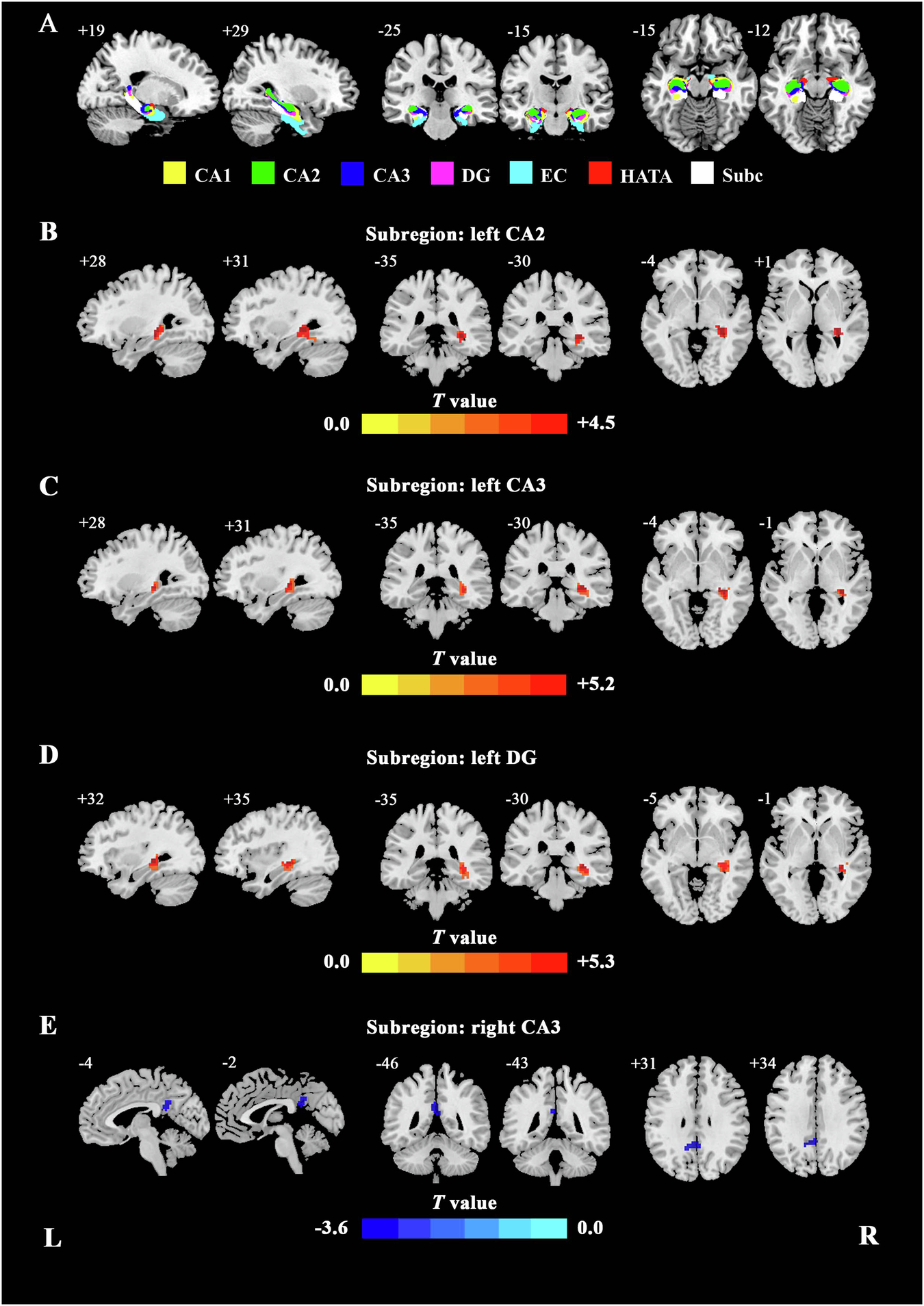 Fig. 1: The hippocampal subregions and significant FC differences between the MDD and HCs.