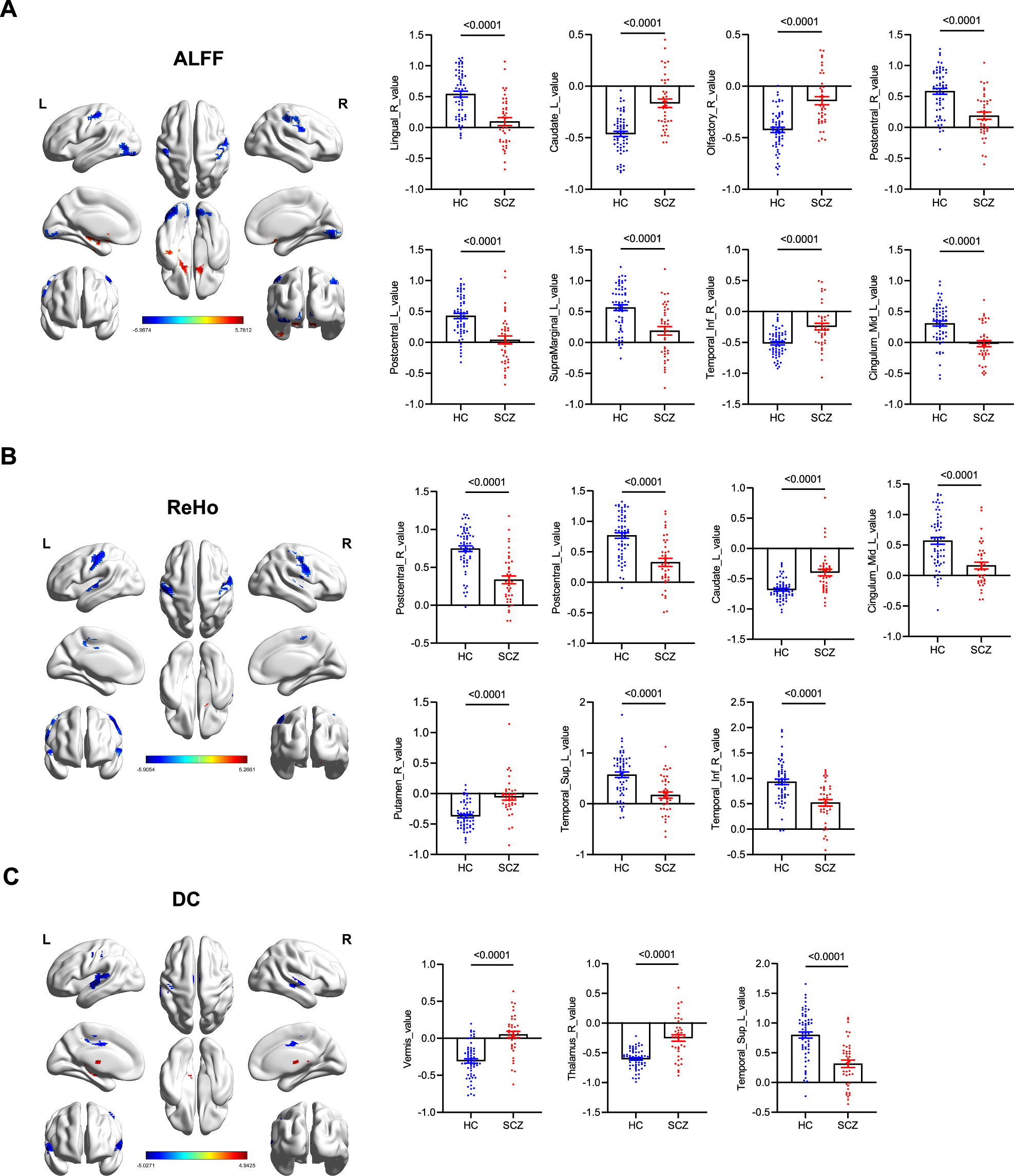 Fig. 3: Functional magnetic resonance imaging (fMRI) analysis in schizophrenia patients and healthy controls.