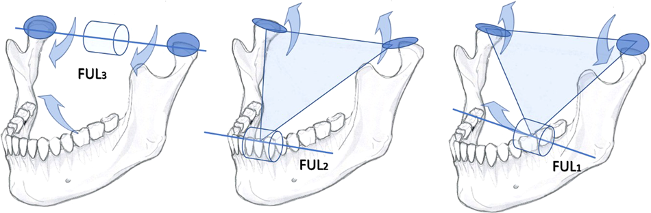 Essential requirements of a non-occlusal mandibu- lar reference