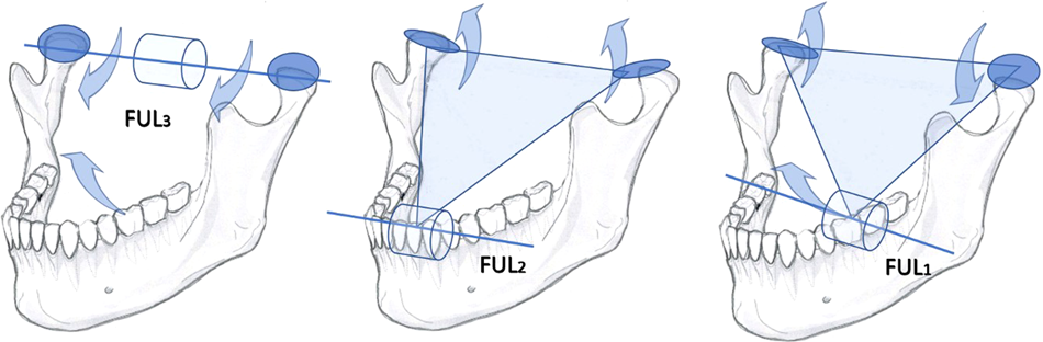 Diagrammatic representation of the normal anatomy of the mandibular