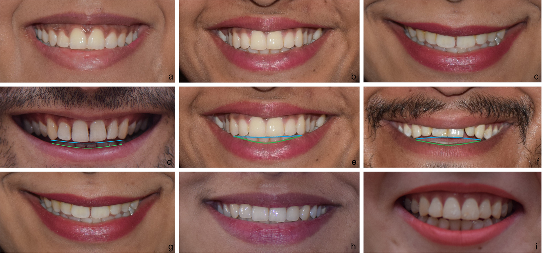 Analysis of different characteristics of smile | BDJ Open