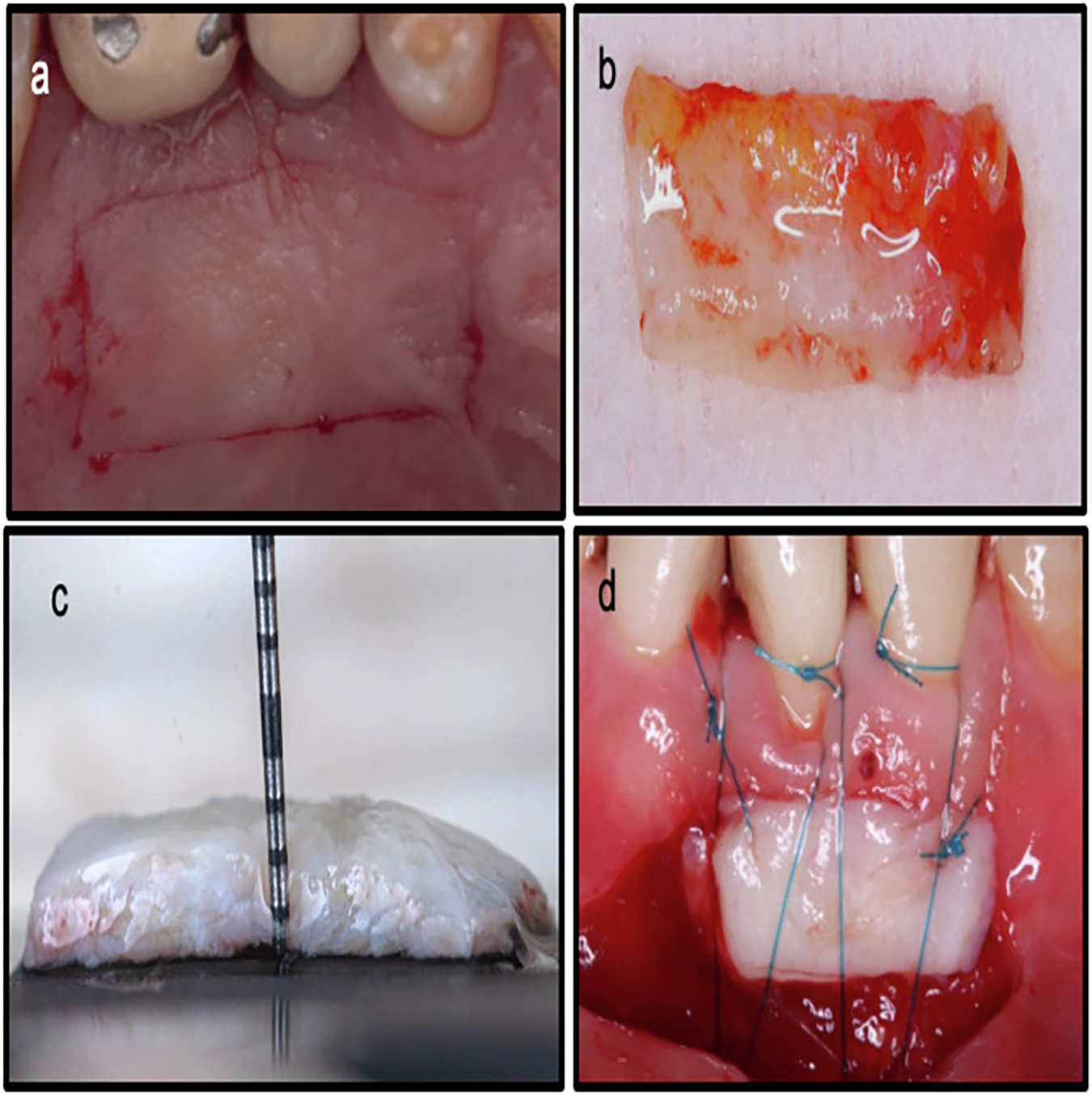 The effect of nano-bio fusion gingival gel versus palatal stent on the  palatal wound healing after harvesting free gingival graft: a randomized  controlled clinical trial | BDJ Open, image size:1350x1354