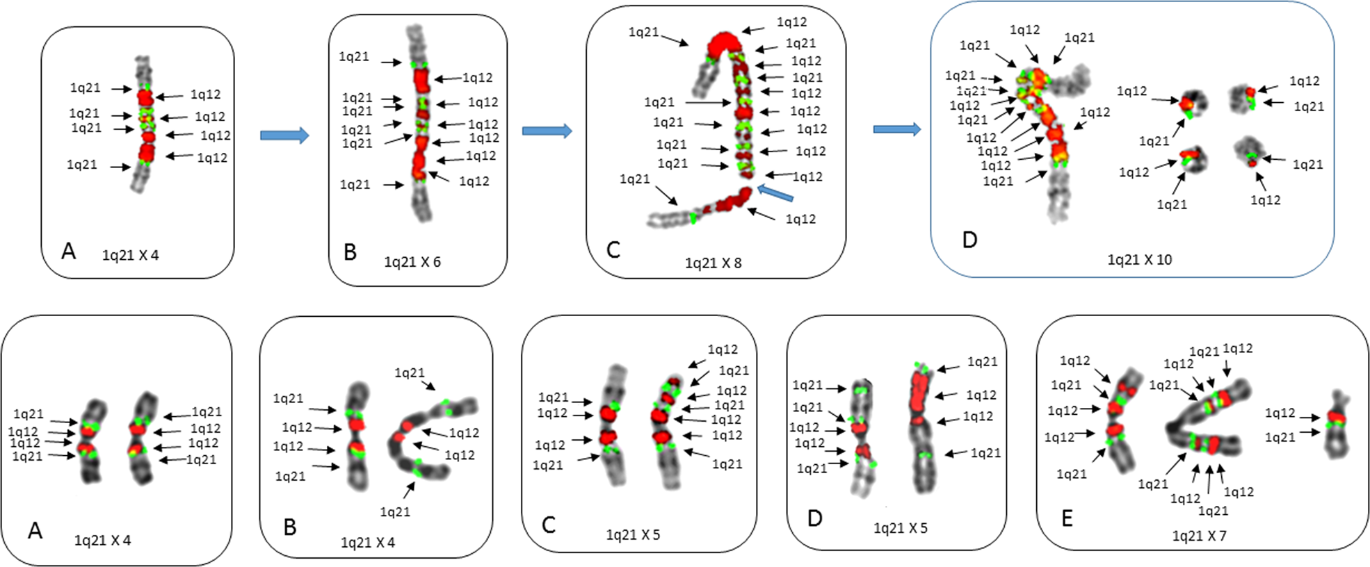 Fig. 2: Metaphase cells from patients demonstrating different types of progression events involving isochromosomes 1q.