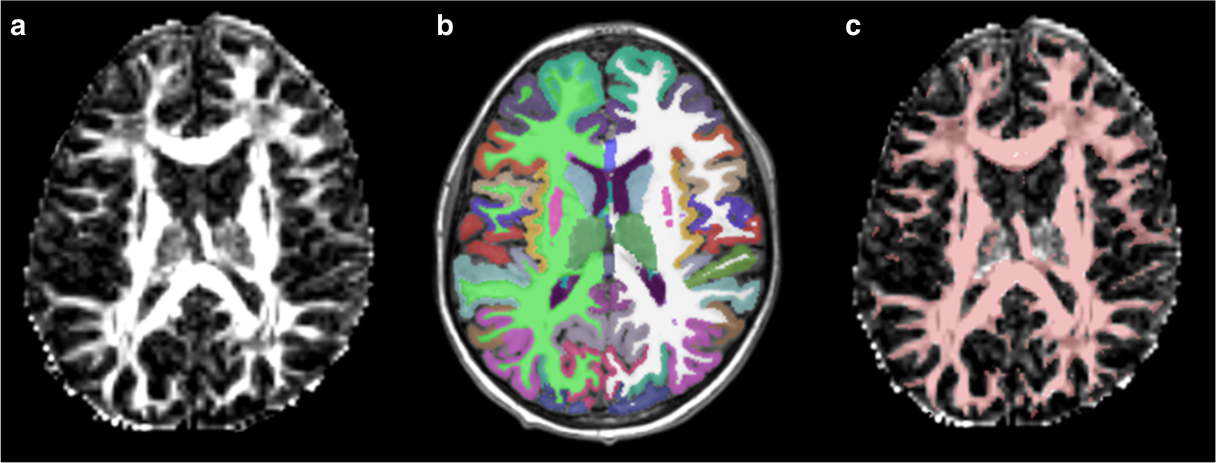 Hematopoietic stem cell transplantation reverses white matter injury  measured by diffusion-tensor imaging (DTI) in sickle cell disease patients  | Bone Marrow Transplantation
