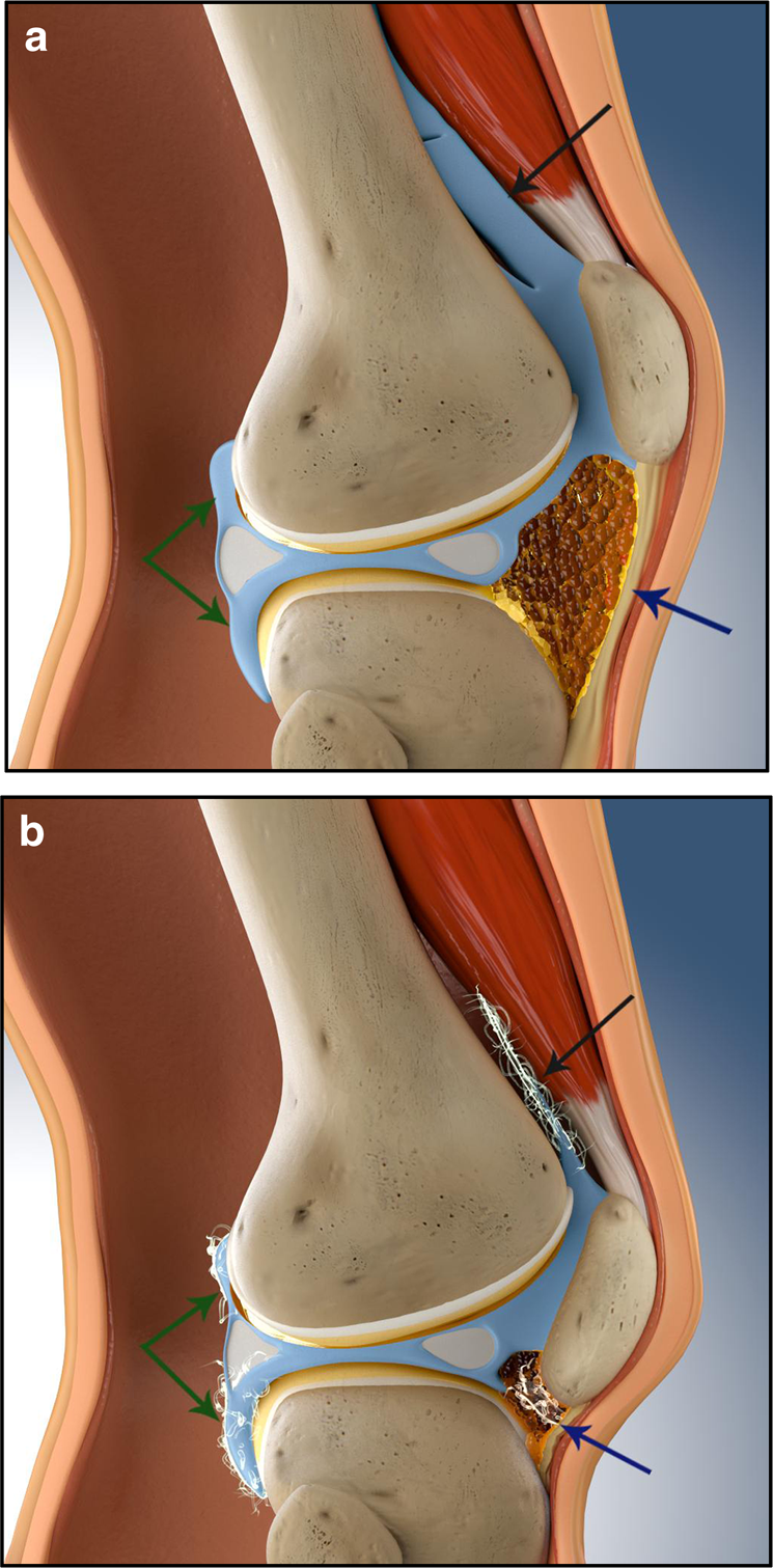 Pathological mechanisms and therapeutic outlooks for arthrofibrosis | Bone  Research